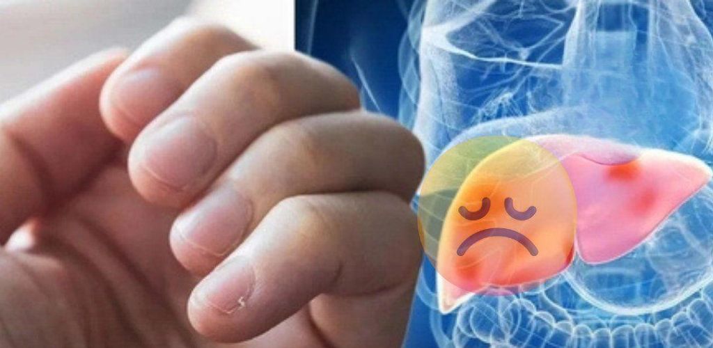 Las personas con insuficiencia hepática suelen presentar tres signos